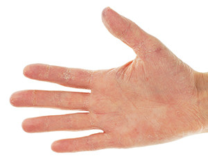 Eczema-Dermatitis-On-Palm-300